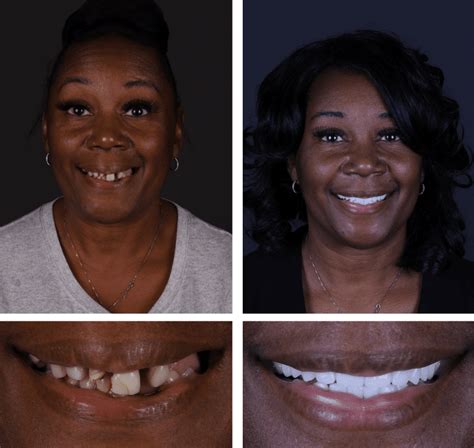 jax implants and dentures|Home 